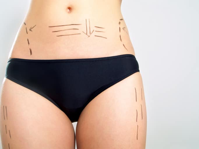 mezoterapia